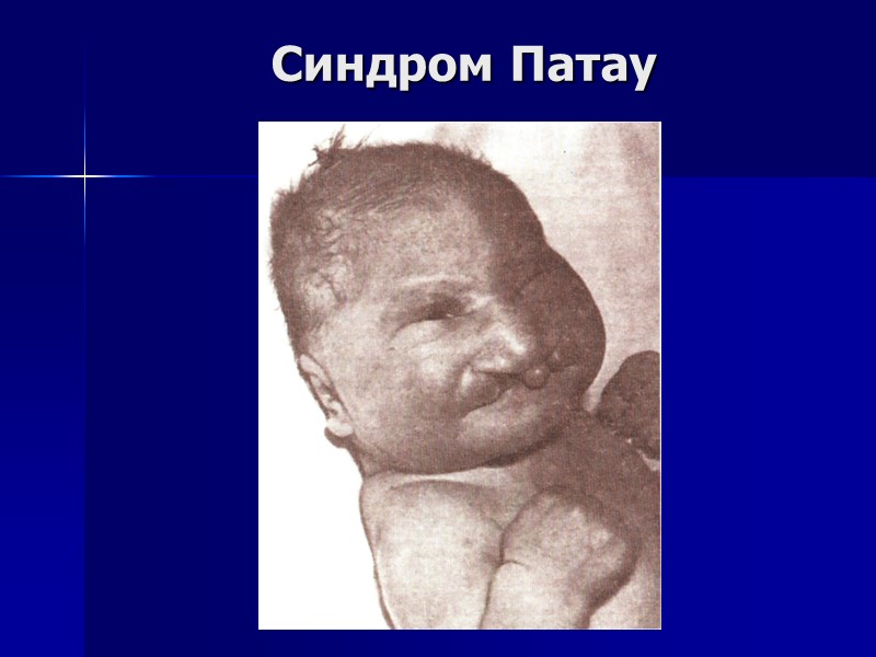 Синдром Патау